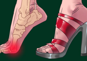 کفش پاشنهبلند چگونه پاها را تغییر میدهد